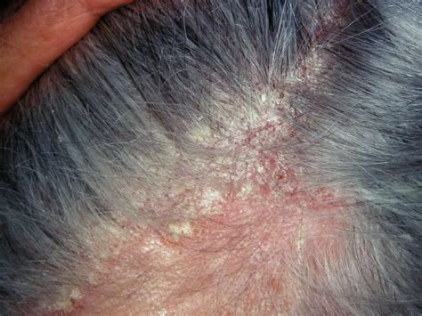 Seborrheic Dermatitis .